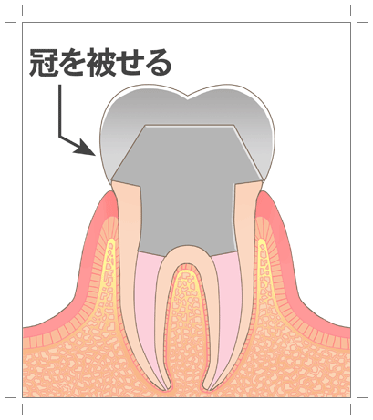 高円寺駅南口徒歩2分の歯医者、高円寺PAL歯科医院の根管治療の流れ