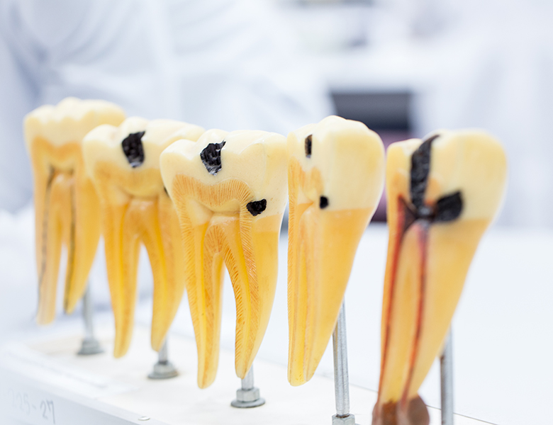 高円寺駅南口徒歩2分の歯医者、高円寺PAL歯科医院のむし歯治療