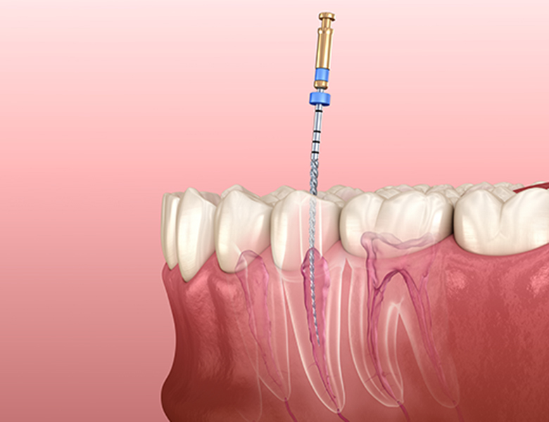 高円寺駅南口徒歩2分の歯医者、高円寺PAL歯科医院の根管治療