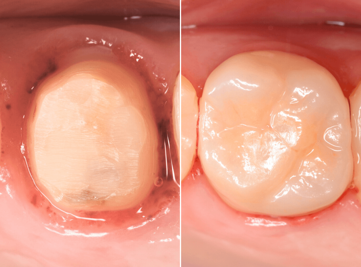 高円寺駅南口徒歩2分の歯医者、高円寺PAL歯科医院のマイクロスコープ診療