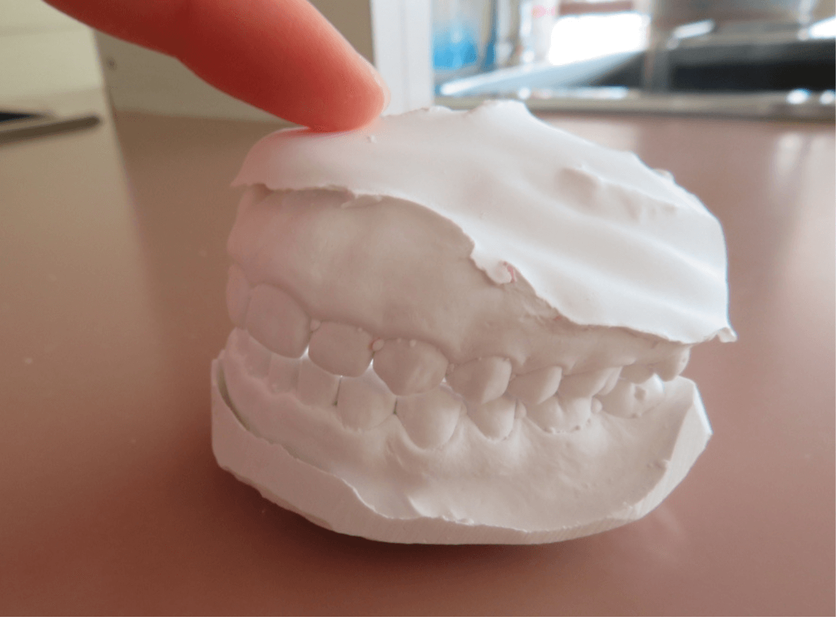 高円寺駅南口徒歩2分の歯医者、高円寺PAL歯科医院の模型による診断