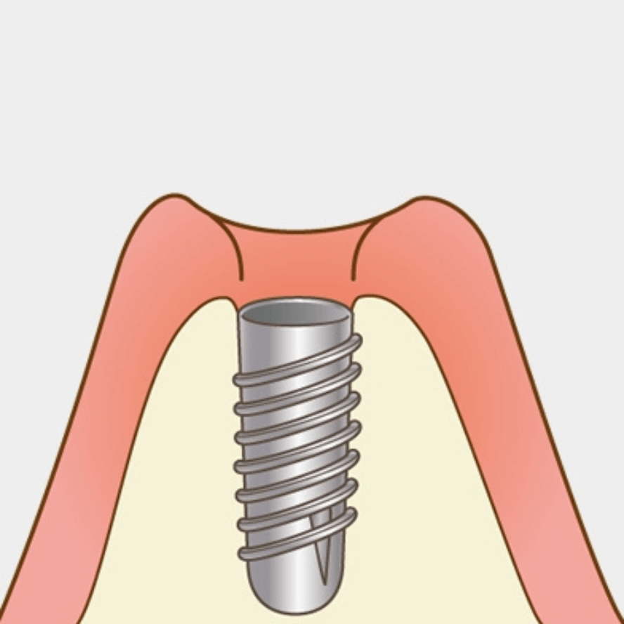 高円寺駅南口徒歩2分の歯医者、高円寺PAL歯科医院のインプラント治療の流れ
