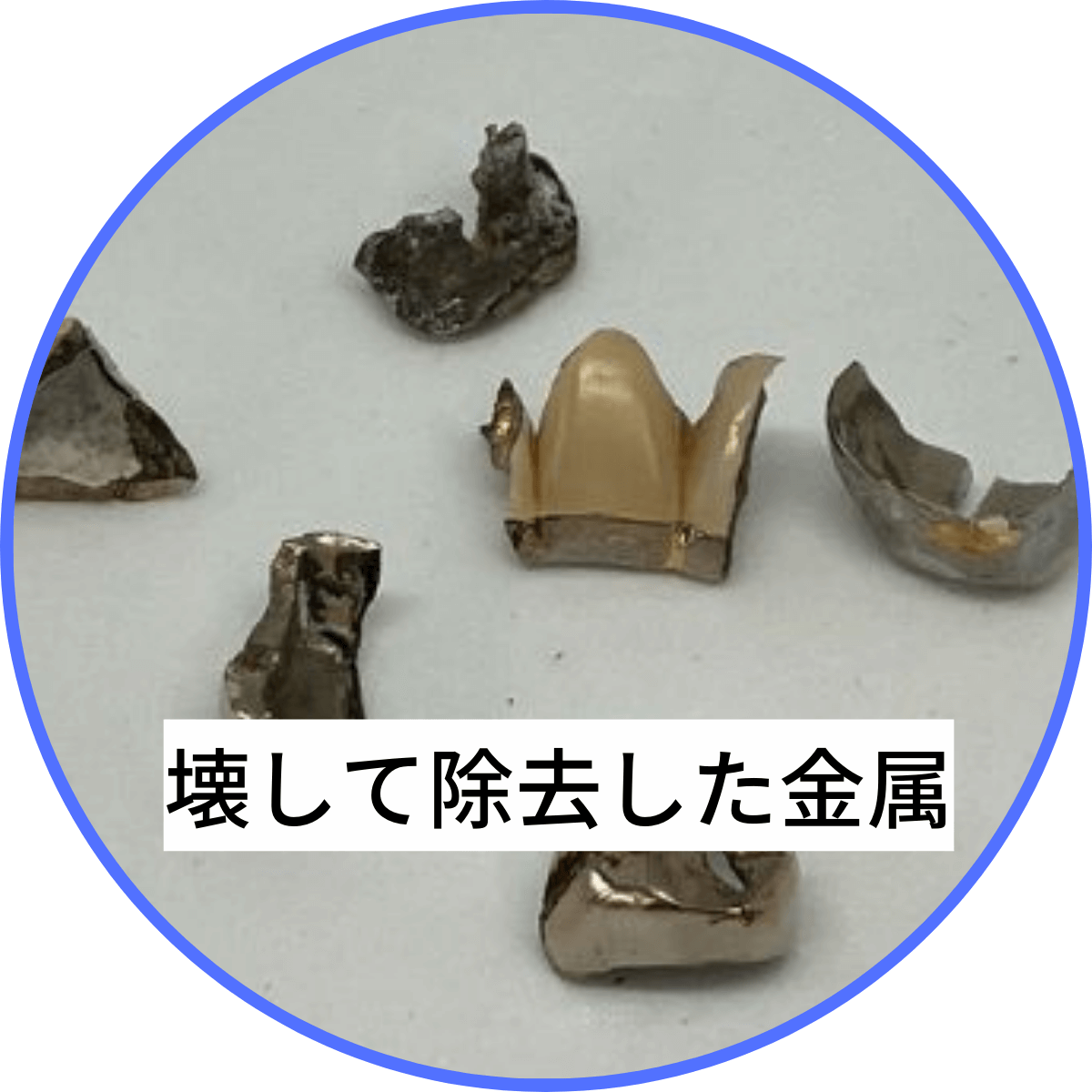 高円寺駅南口徒歩2分の歯医者、高円寺PAL歯科医院のセラミック治療