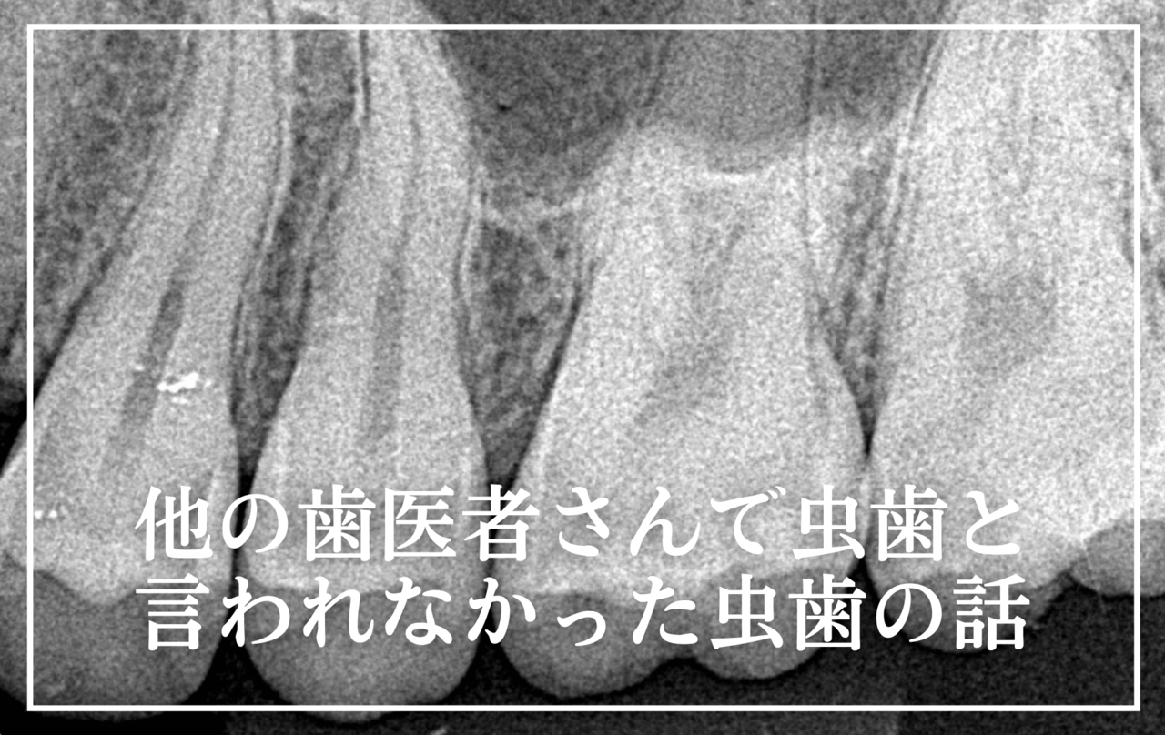 高円寺駅南口徒歩2分の歯医者、高円寺PAL歯科医院の他の歯医者さんで、虫歯と言われなかった虫歯の話