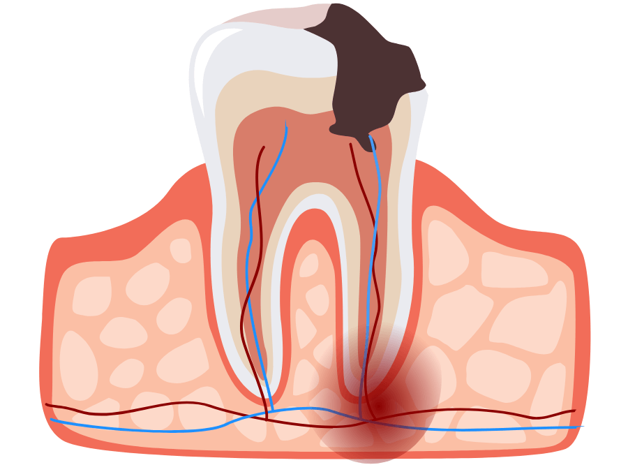 高円寺駅南口徒歩2分の歯医者、高円寺PAL歯科医院のむし歯治療