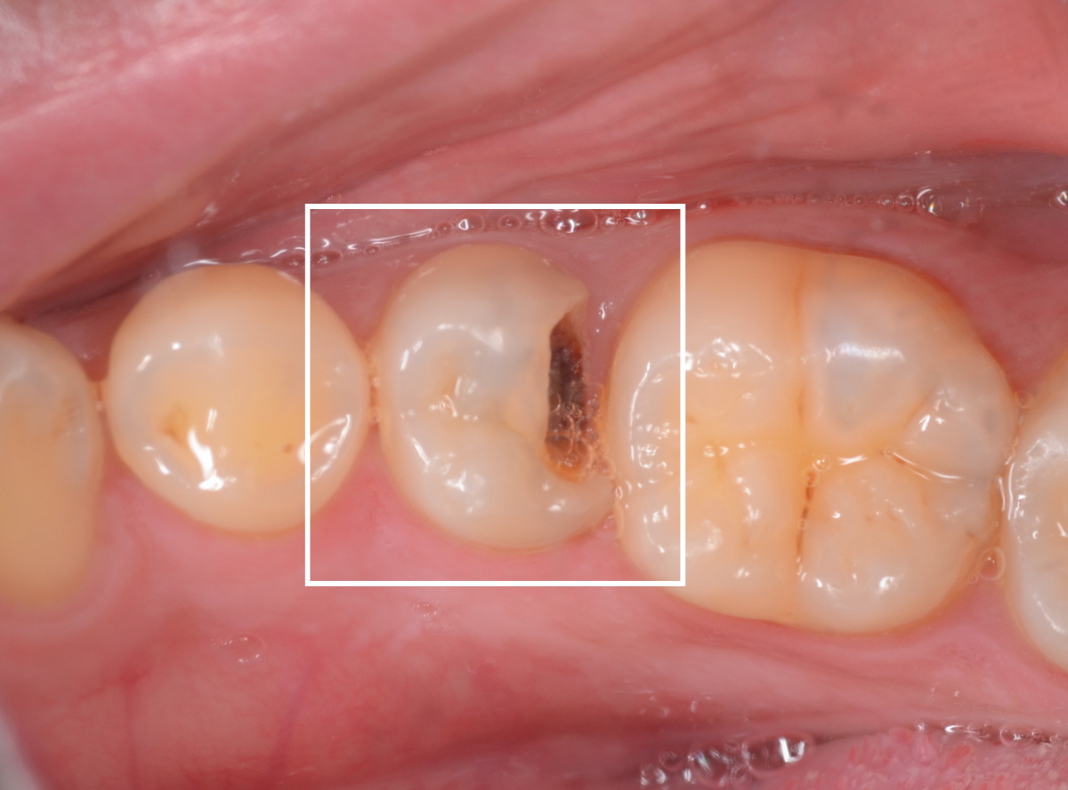高円寺駅南口徒歩2分の歯医者、高円寺PAL歯科医院の歯を残す治療