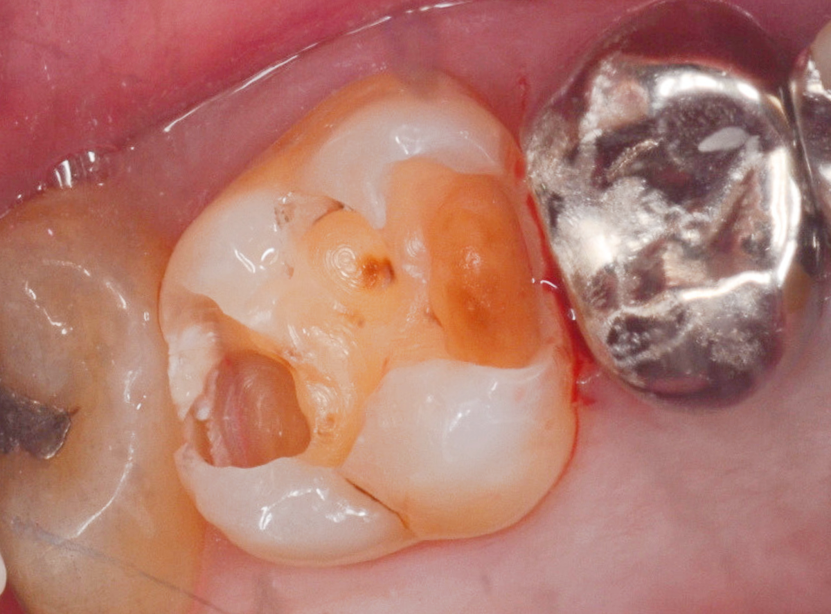 高円寺駅南口徒歩2分の歯医者、高円寺PAL歯科医院の歯を残す治療