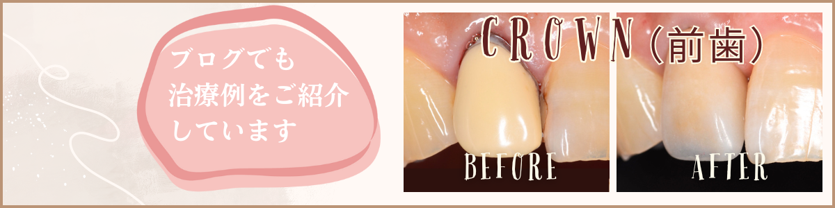 高円寺駅南口徒歩2分の歯医者、高円寺PAL歯科医院のセラミック治療