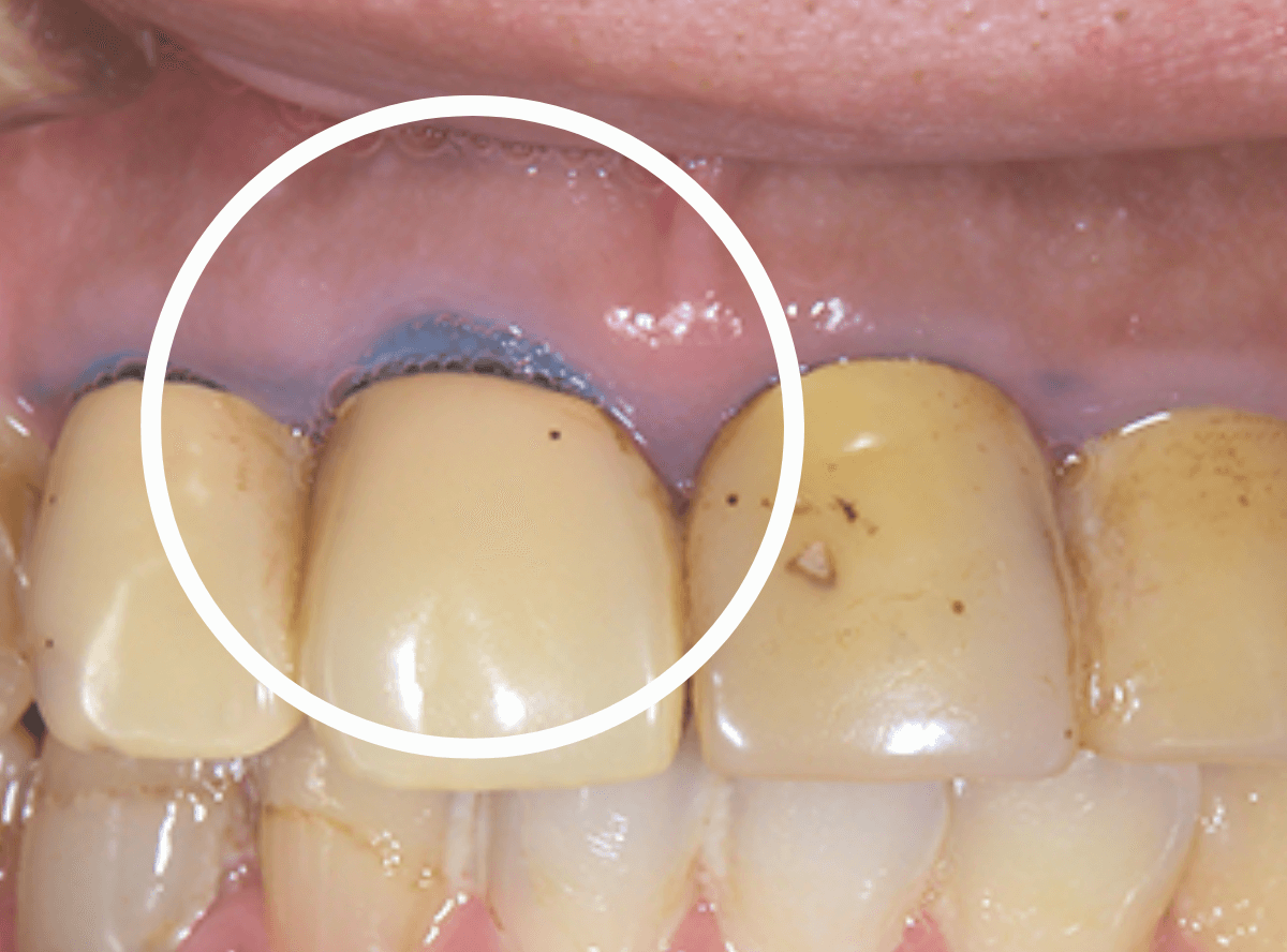 高円寺駅南口徒歩2分の歯医者、高円寺PAL歯科医院のセラミック治療