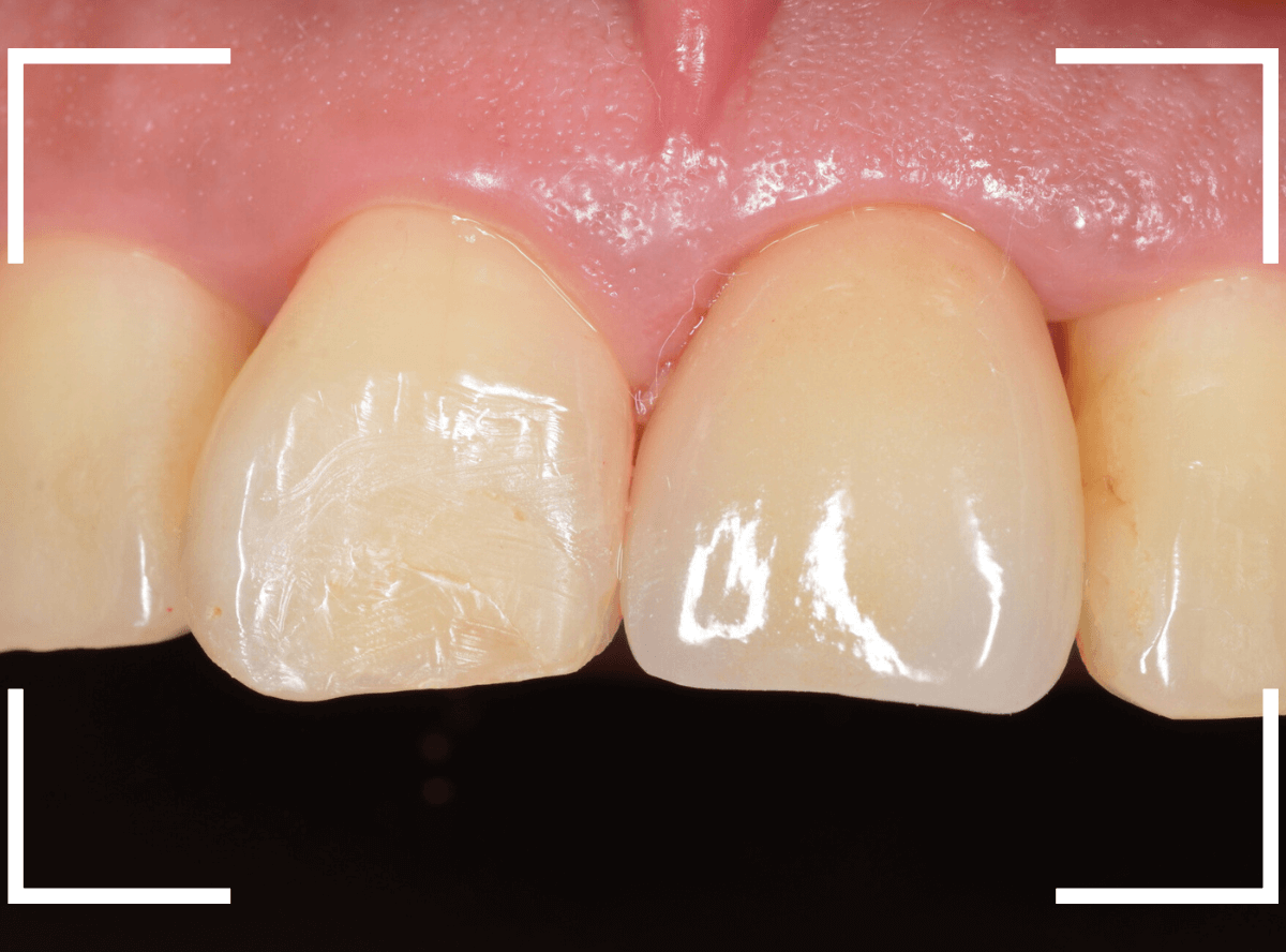 セラミック治療(前歯・クラウン)5-13