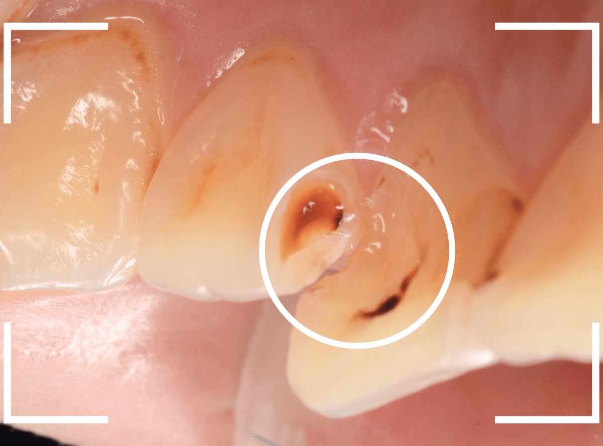 コンポジットレジン治療6-3