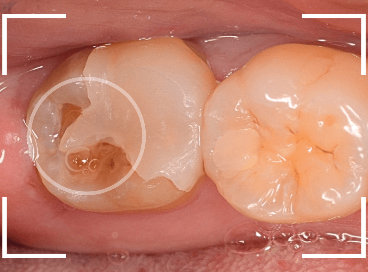 セラミック治療(インレー)20-1