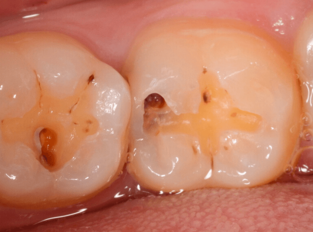 レントゲンでわかりづらい虫歯3-3