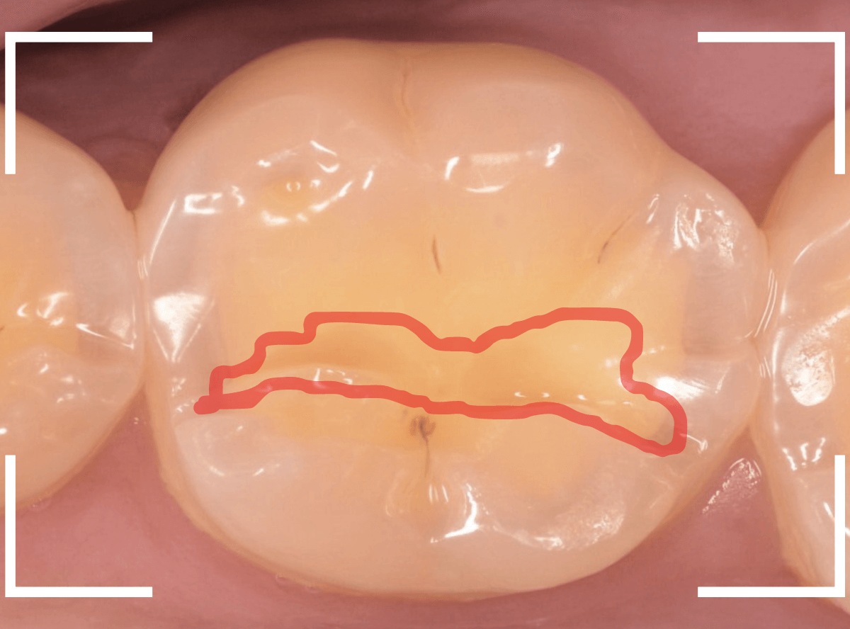 知覚過敏の画像4-2