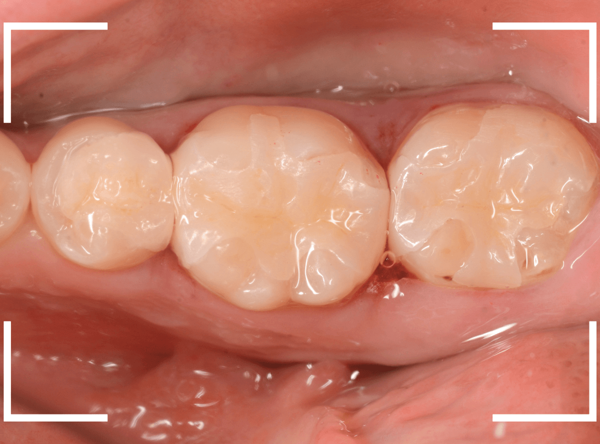 歯の治療の器具_ベースセメント-8