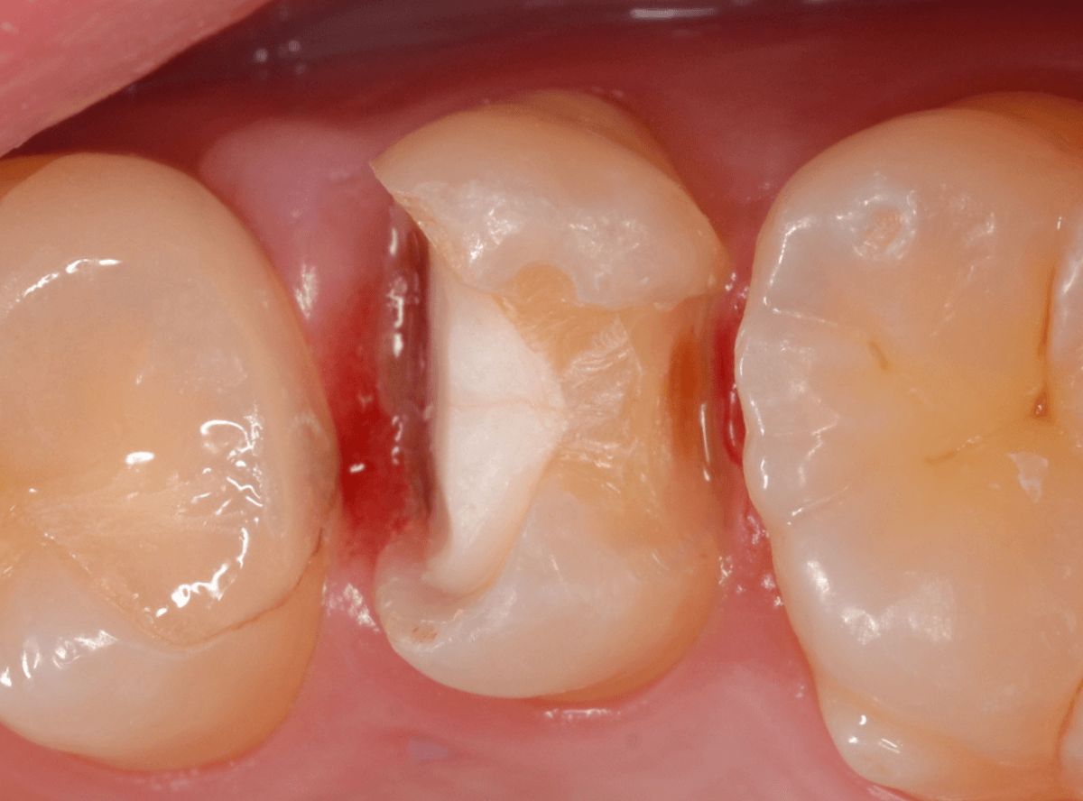 セラミック治療(インレー)15-2