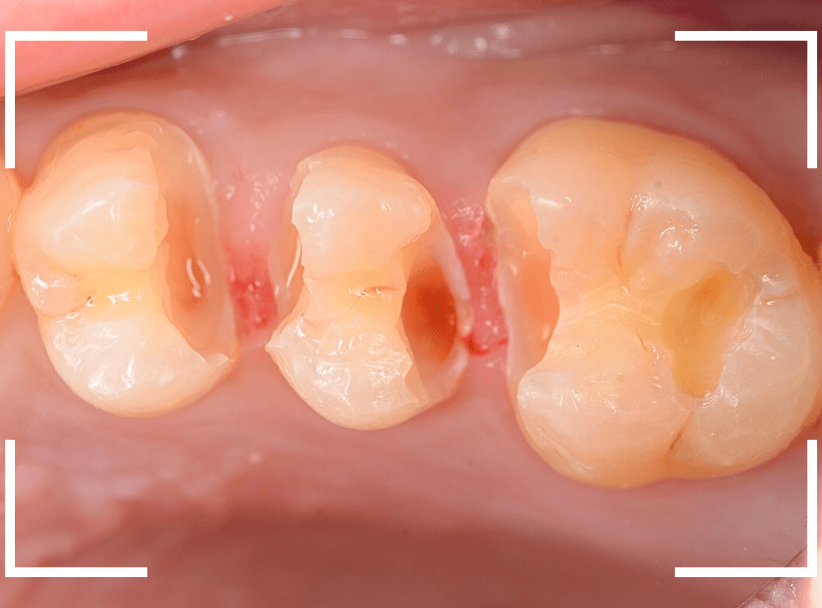 つめものの下の深い深い虫歯17-5