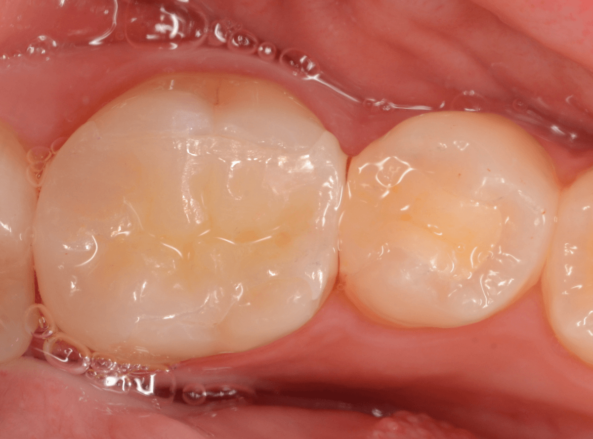 小窩裂溝う蝕1-9