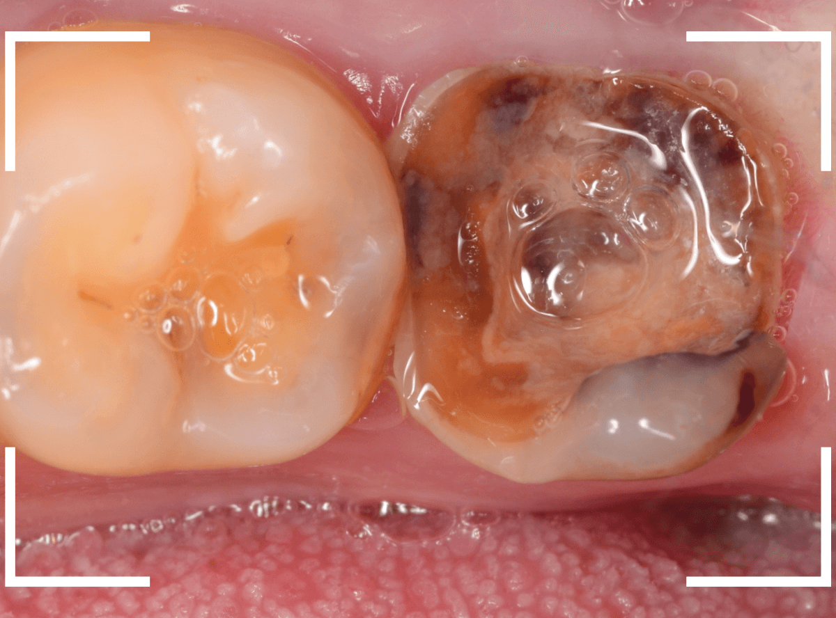 おやしらずの抜歯17-1