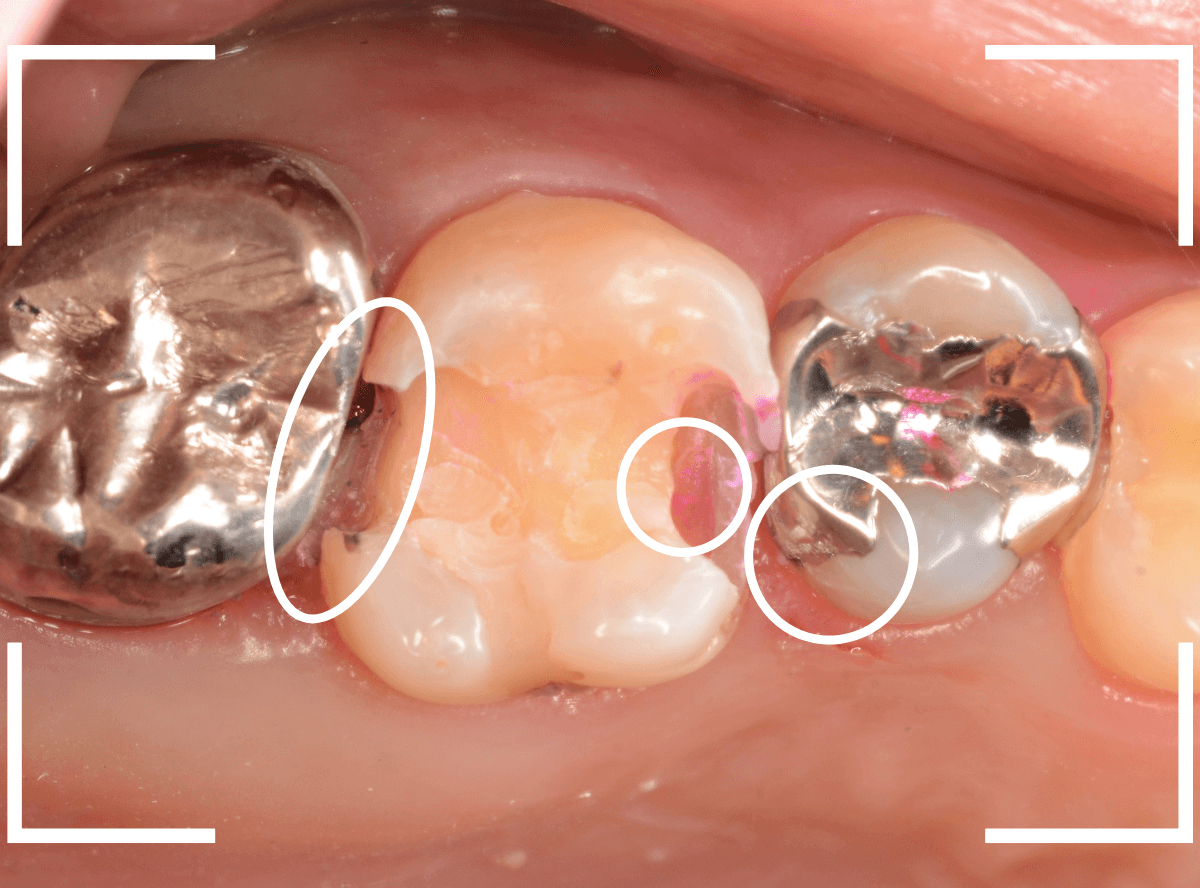 レントゲンでわかりづらい虫歯15-4