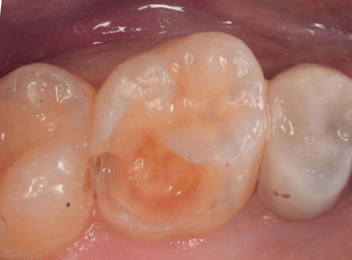 レントゲンでわかりづらい虫歯1-6