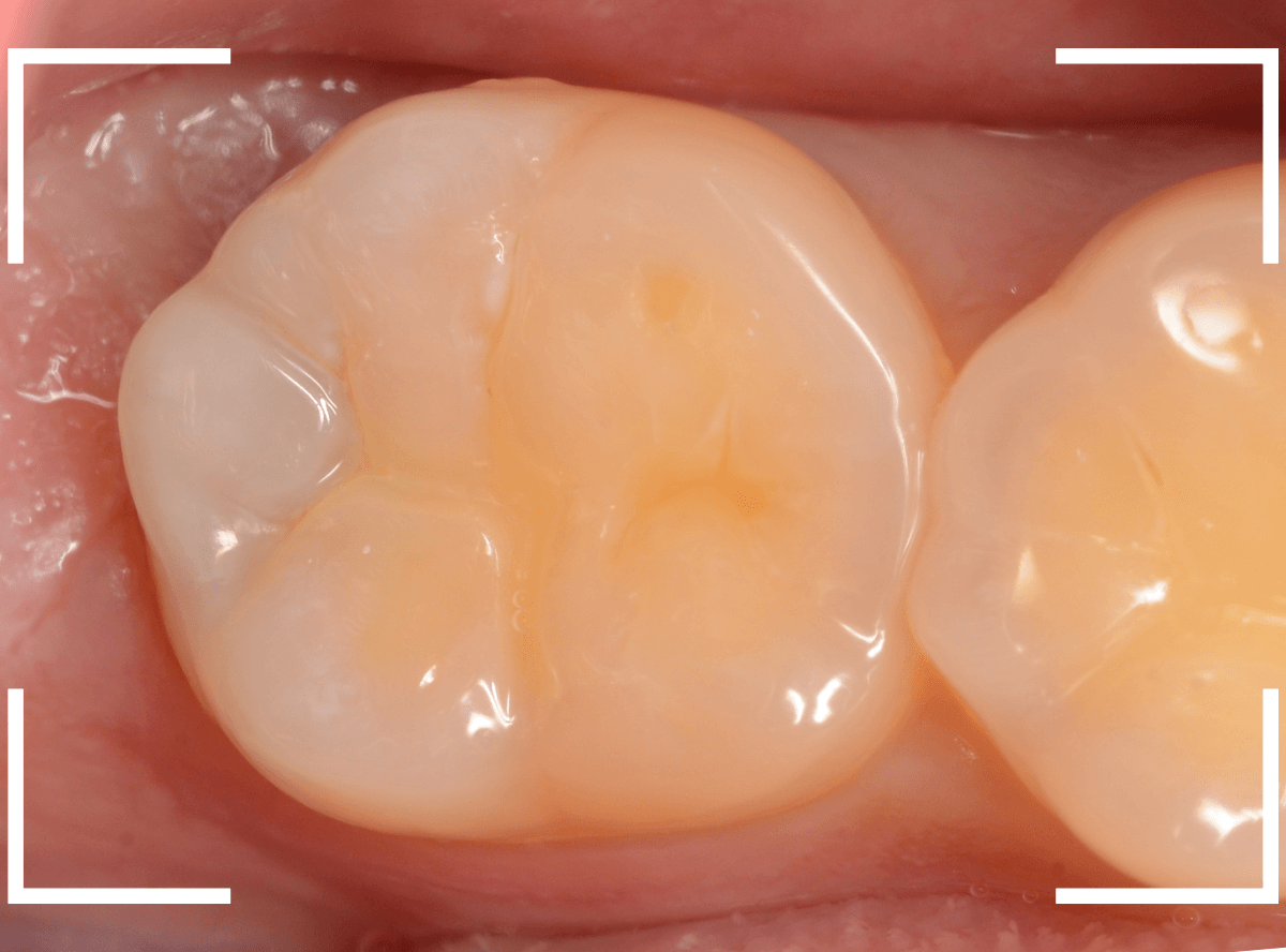 気づかないうちに深い虫歯12-1