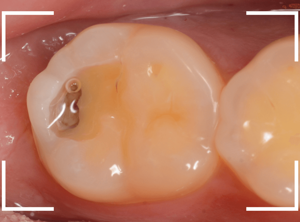 気づかないうちに深い虫歯12-3