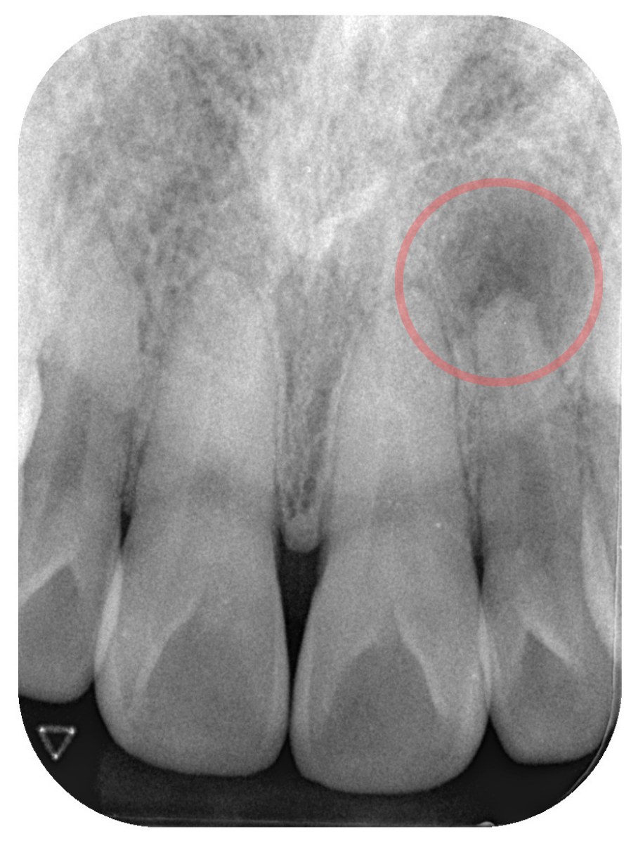 虫歯じゃないけど、歯がとても痛くて眠れない(画像)-1