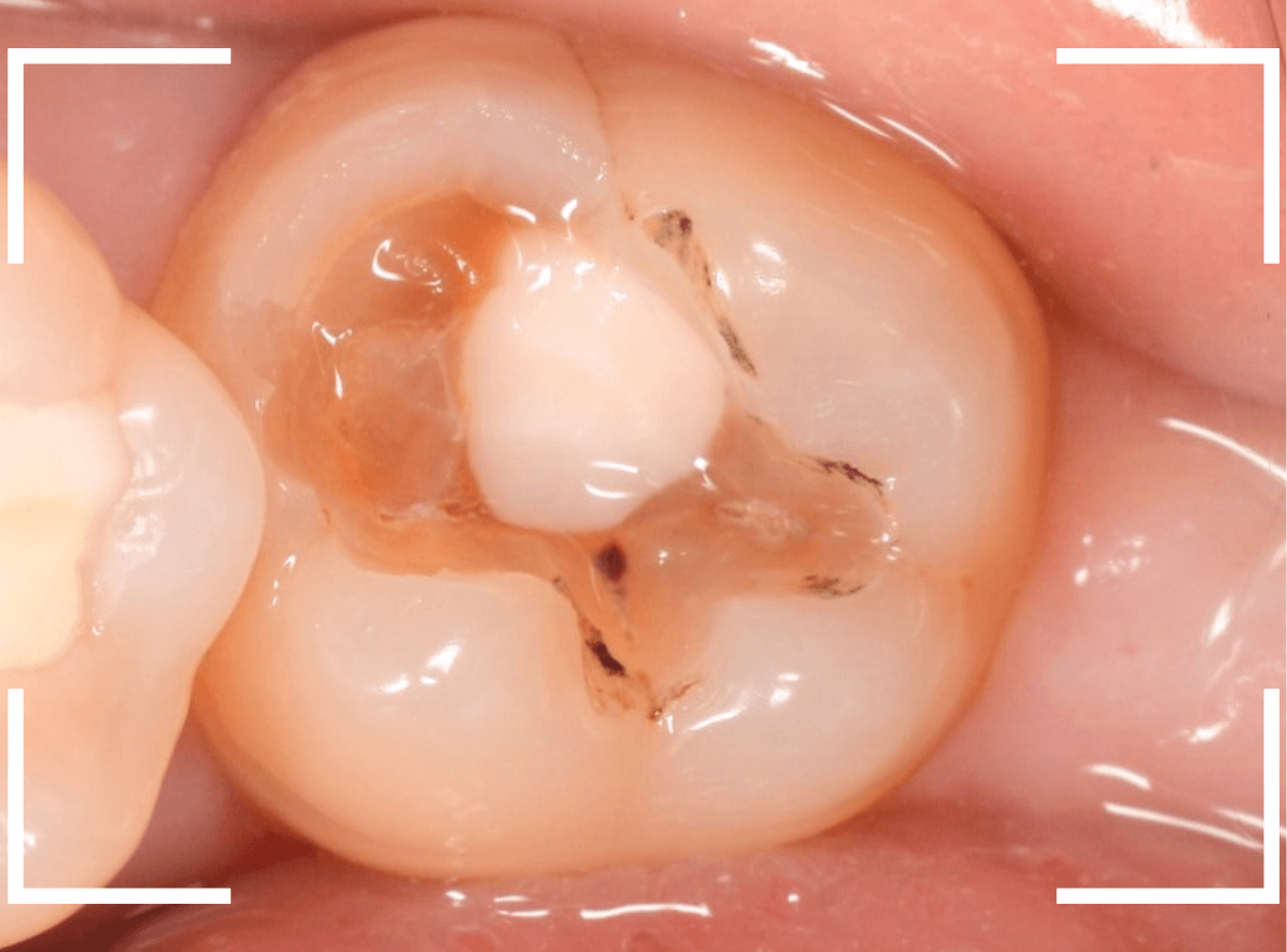 つめものの下の深い深い虫歯20-1