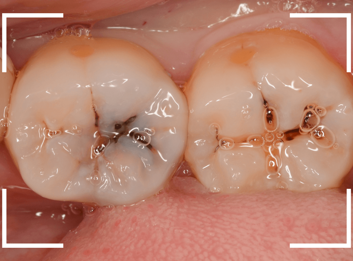 小窩裂溝う蝕2-1