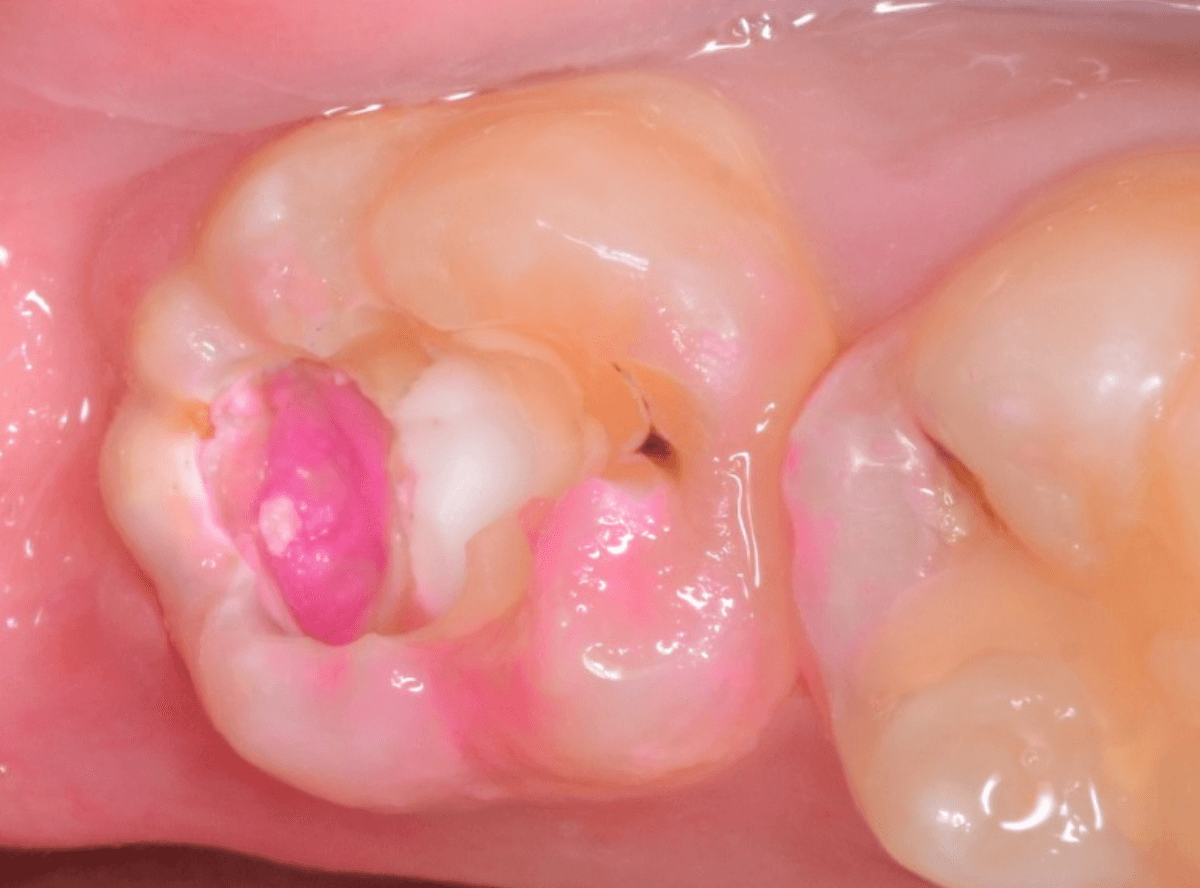 つめものの下の深い深い虫歯11-1