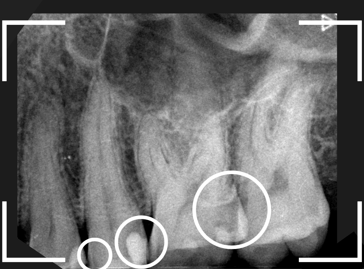 セラミック治療(インレー)24-2