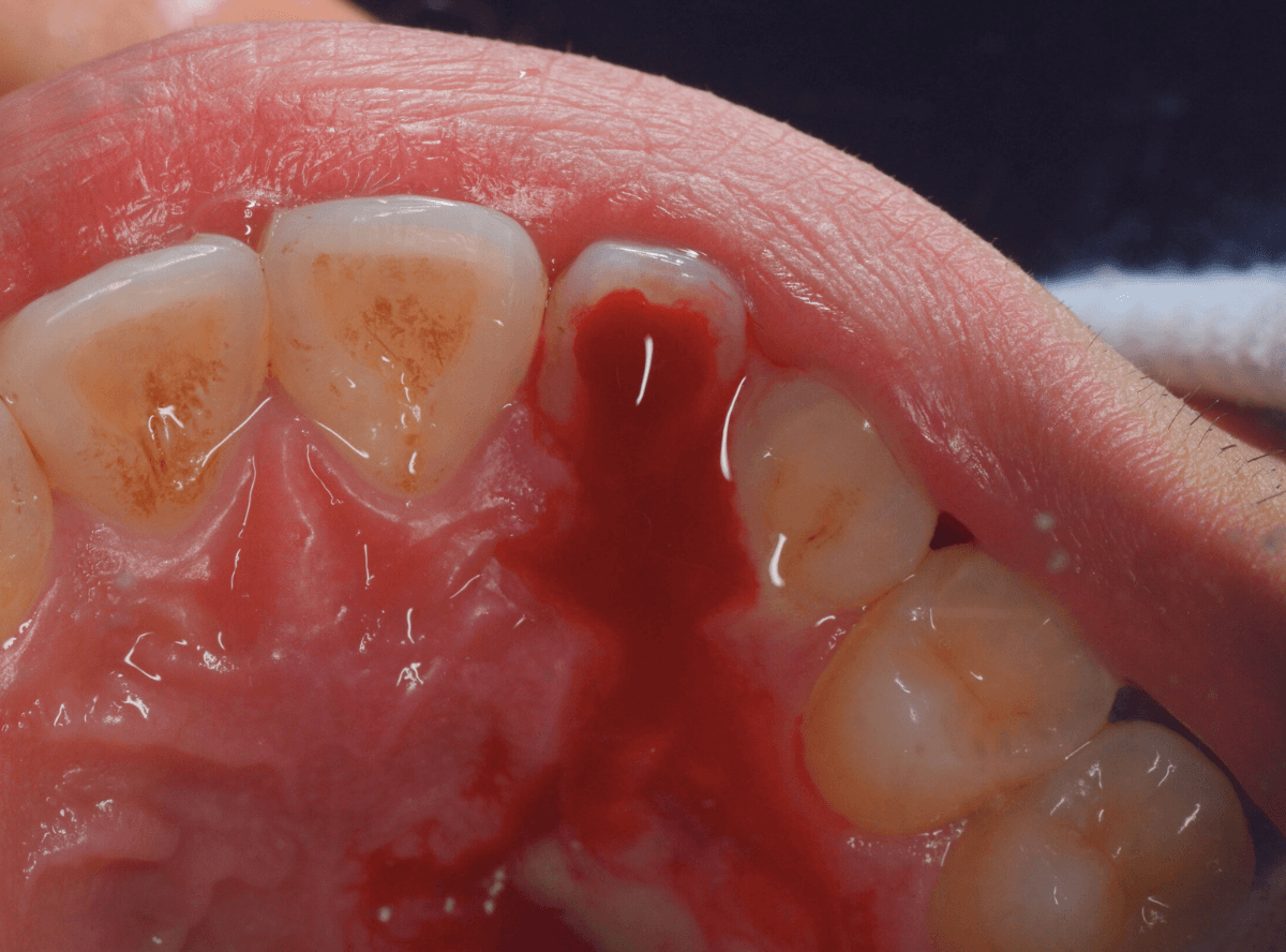 虫歯じゃないけど、歯がとても痛くて眠れない(画像)-2