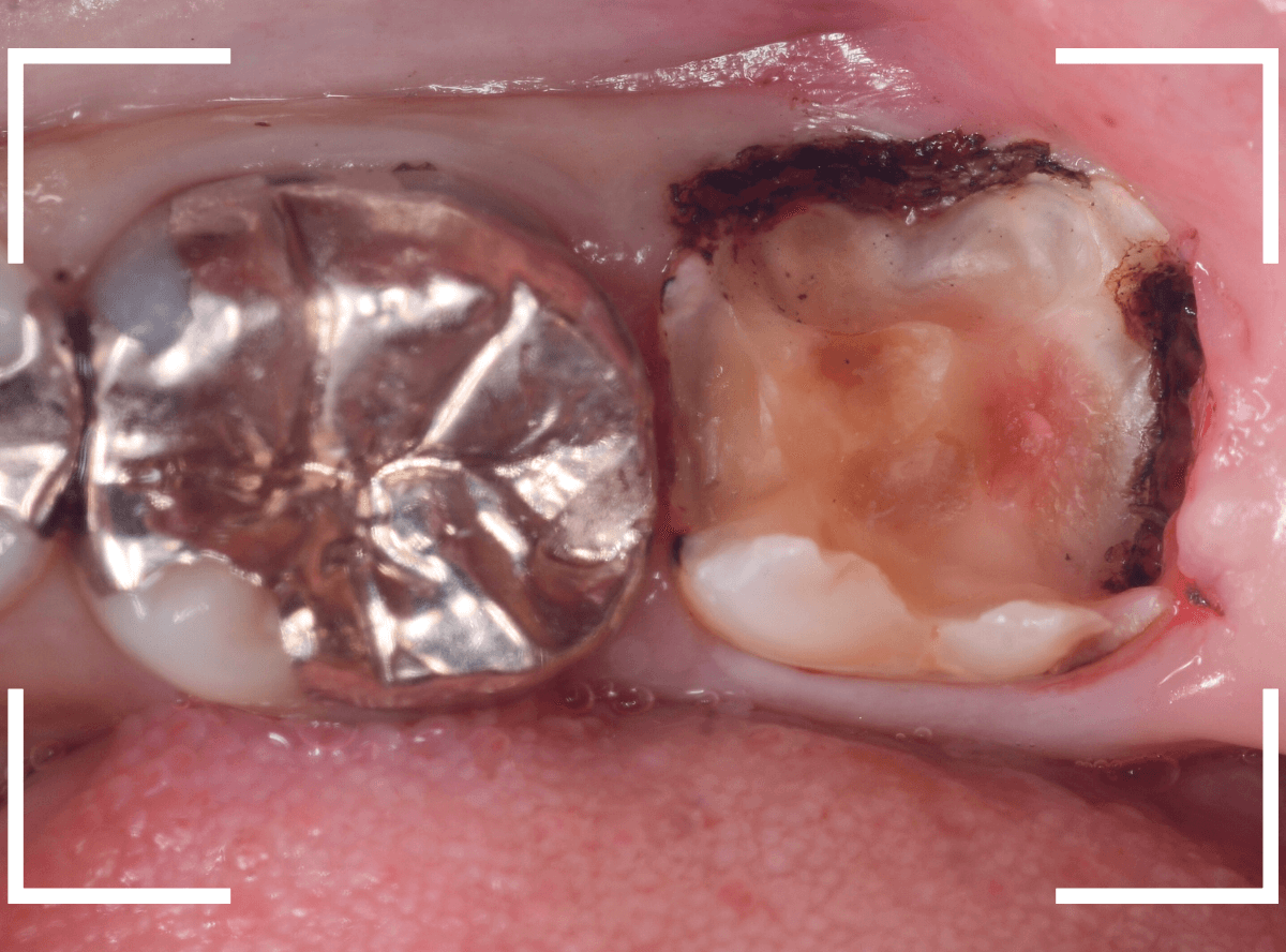 つめものの下の深い虫歯(画像)10-1