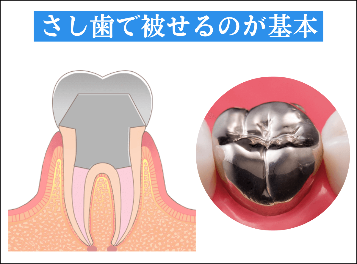 つめものが取れた歯の治療の画像-3