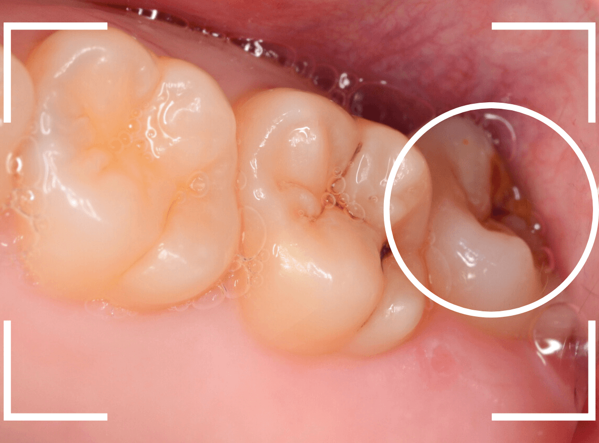 おやしらずの抜歯10-1