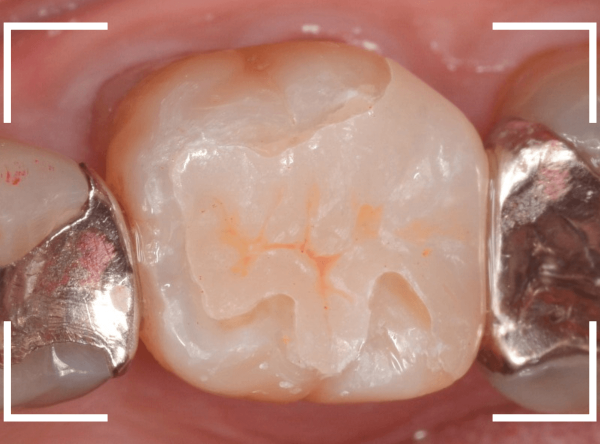 セラミック治療(インレー)17-6