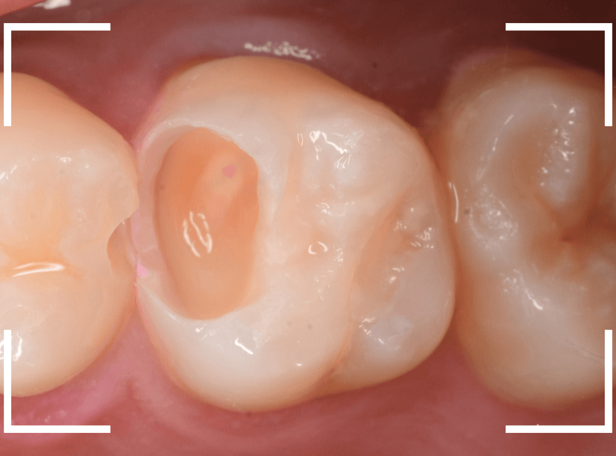 気づかないうちに深い虫歯4-5