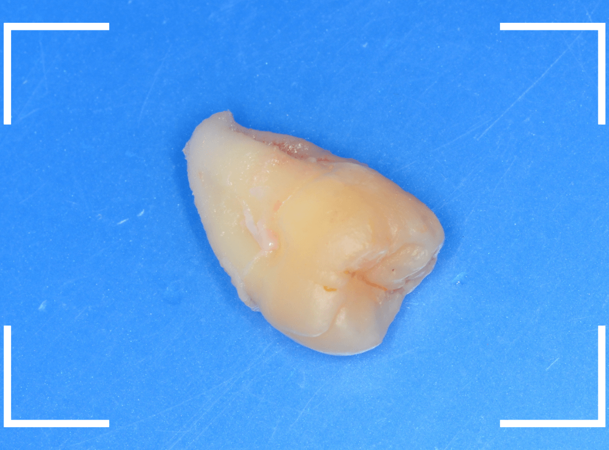 おやしらずの抜歯14-3