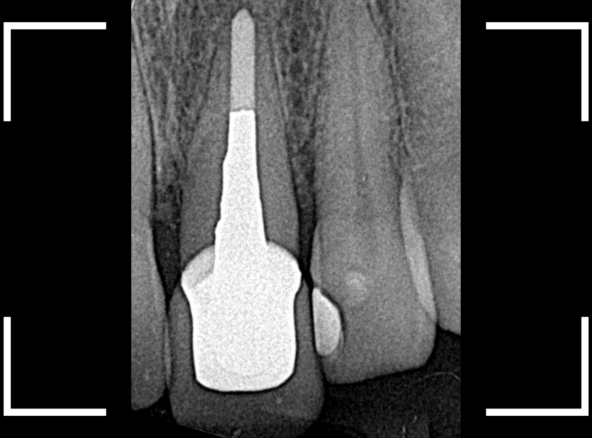 セラミック治療(前歯・クラウン)3-3