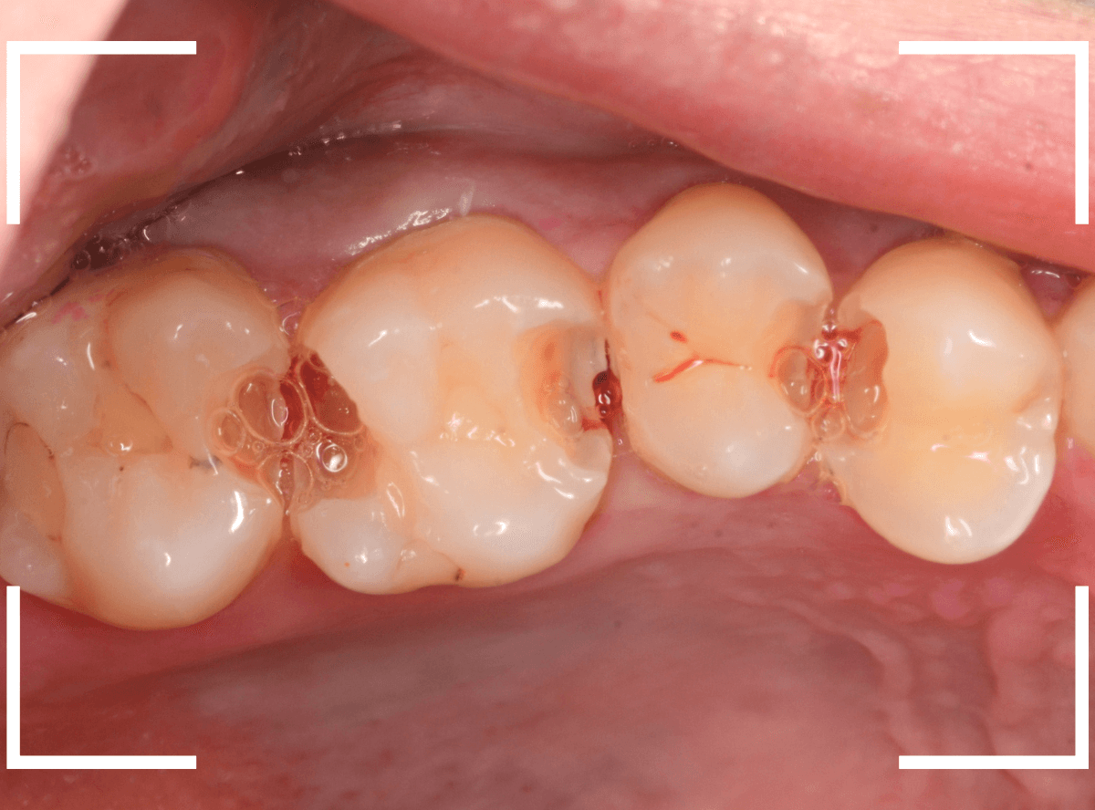 歯と歯の間の虫歯17-6