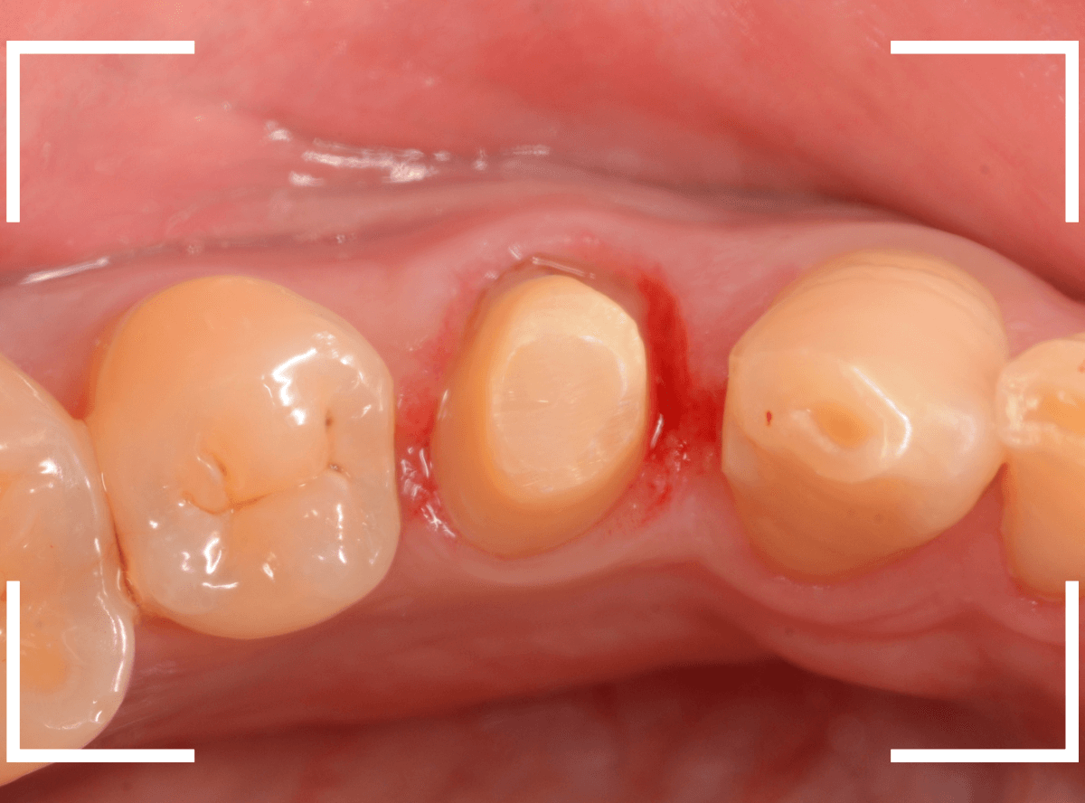 セラミック治療(クラウン・奥歯)11-1