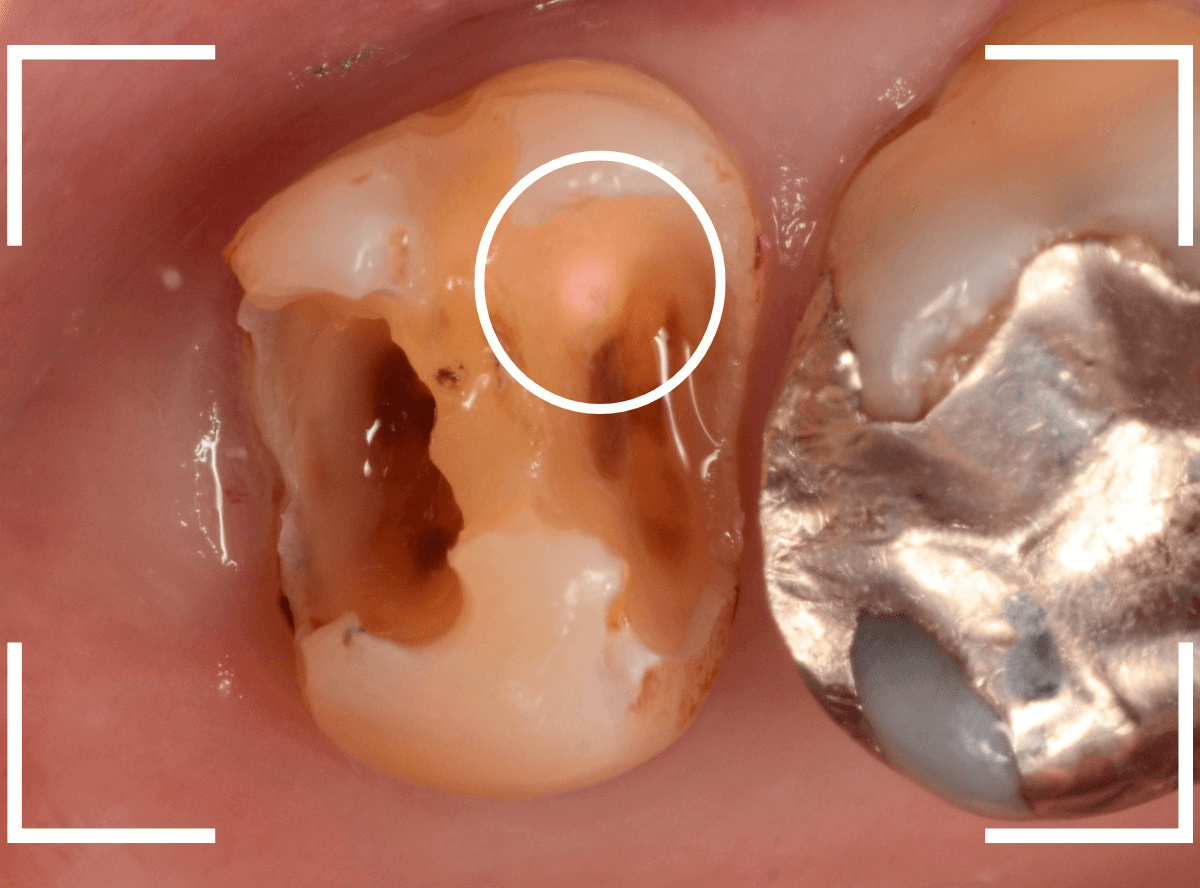 つめものの下の深い虫歯(画像)10-1