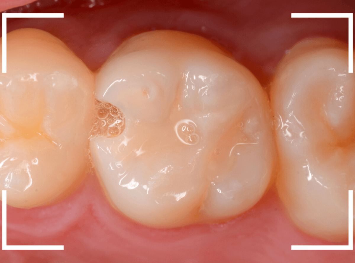 気づかないうちに深い虫歯4-1