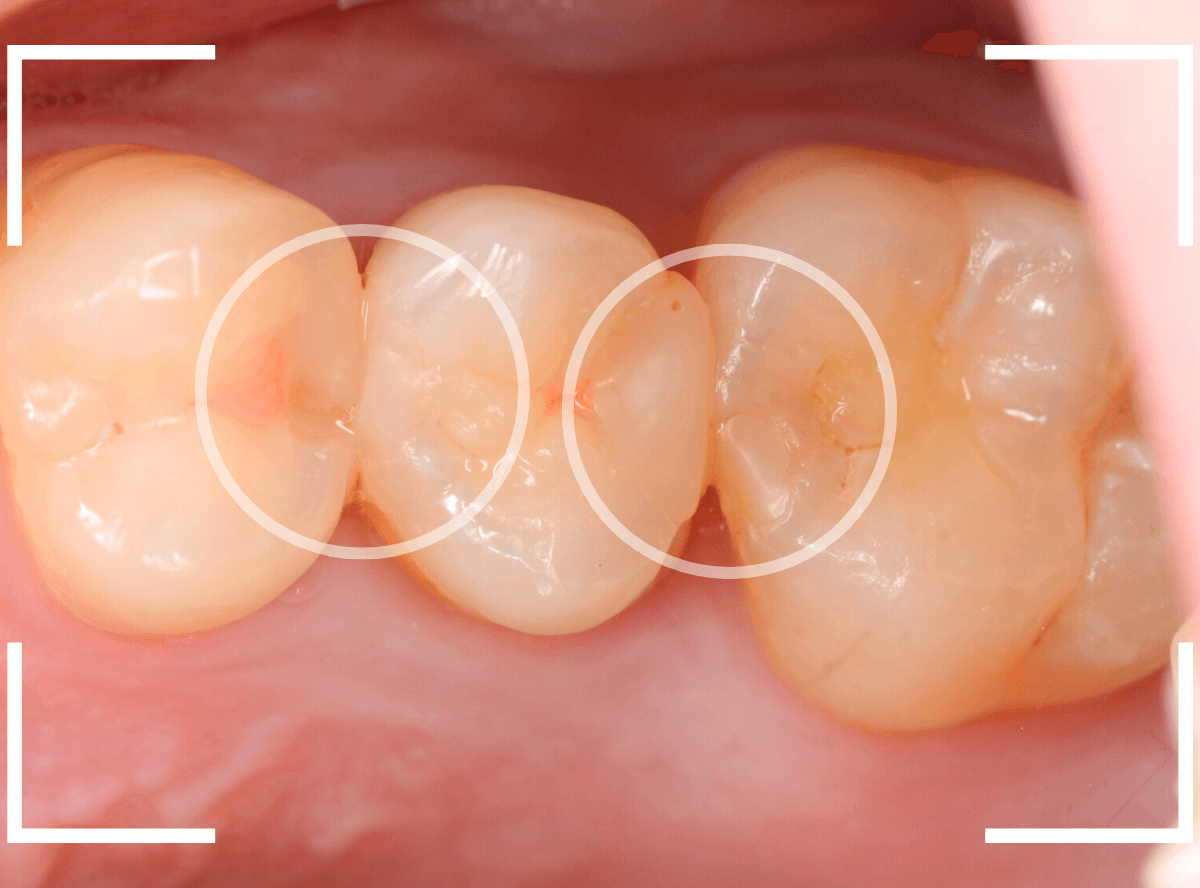 つめものの下の深い深い虫歯17-1