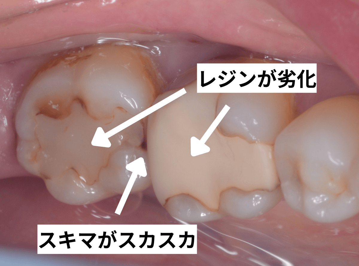 セラミック治療(インレー)8-2