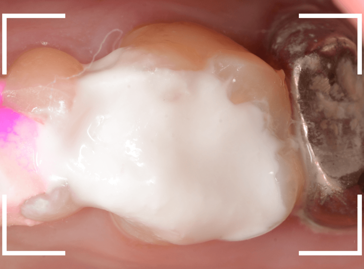 つめものの下の深い深い虫歯20-1