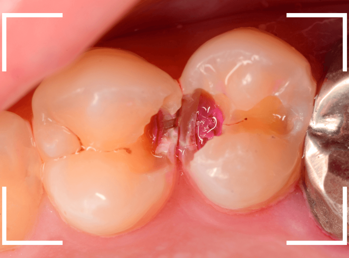 歯と歯の間の虫歯22-4