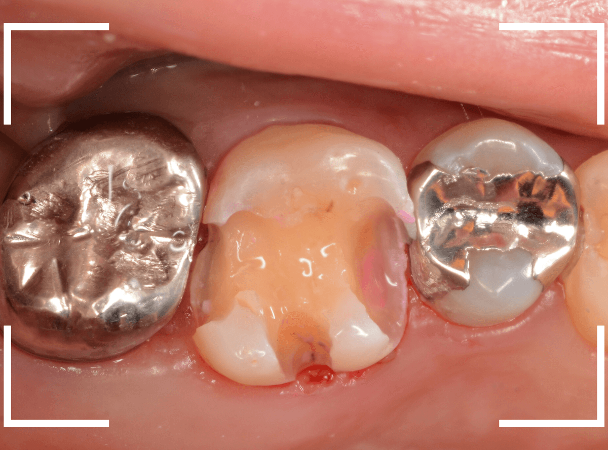 レントゲンでわかりづらい虫歯15-5