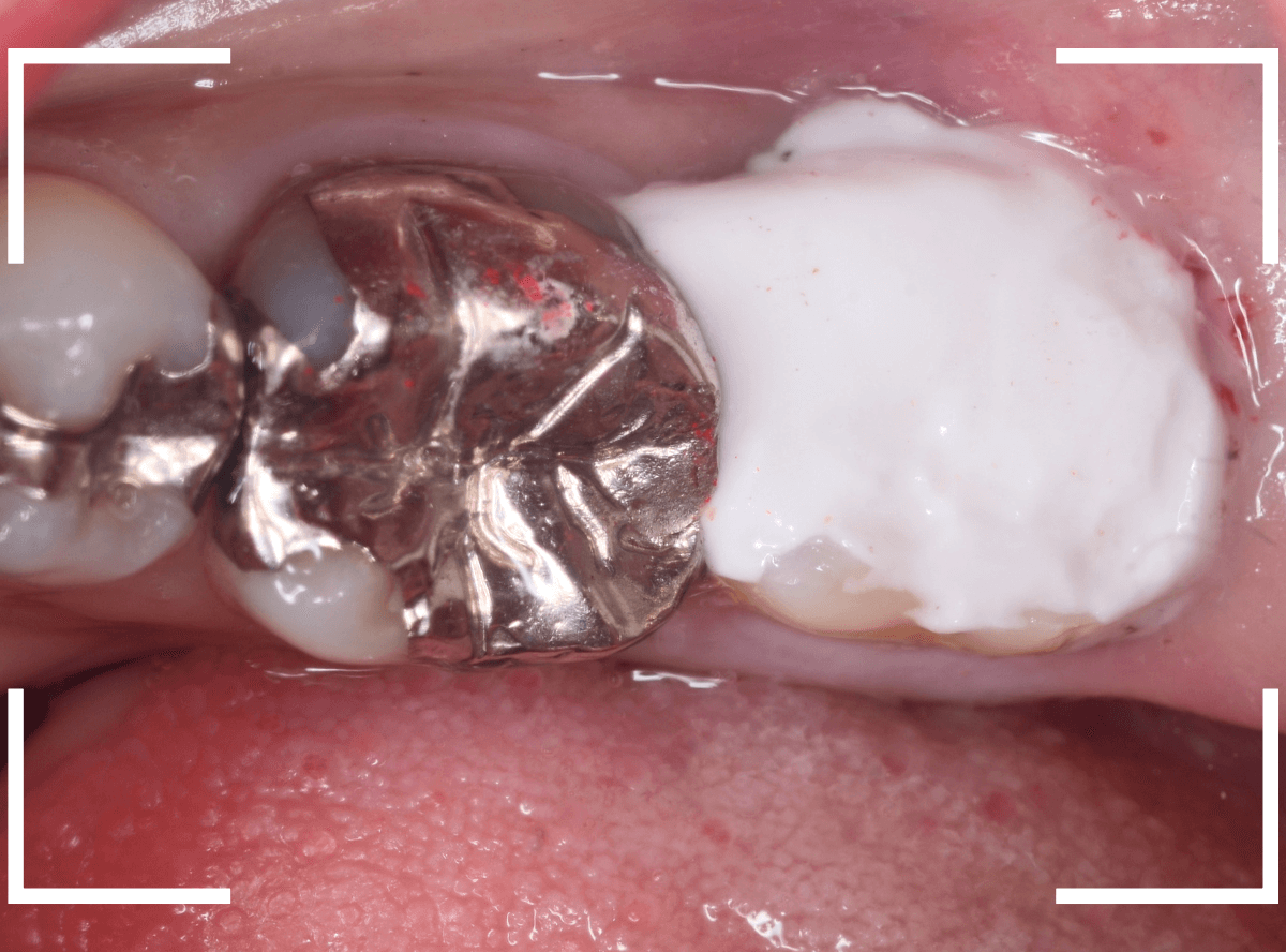 つめものの下の深い虫歯(画像)10-1
